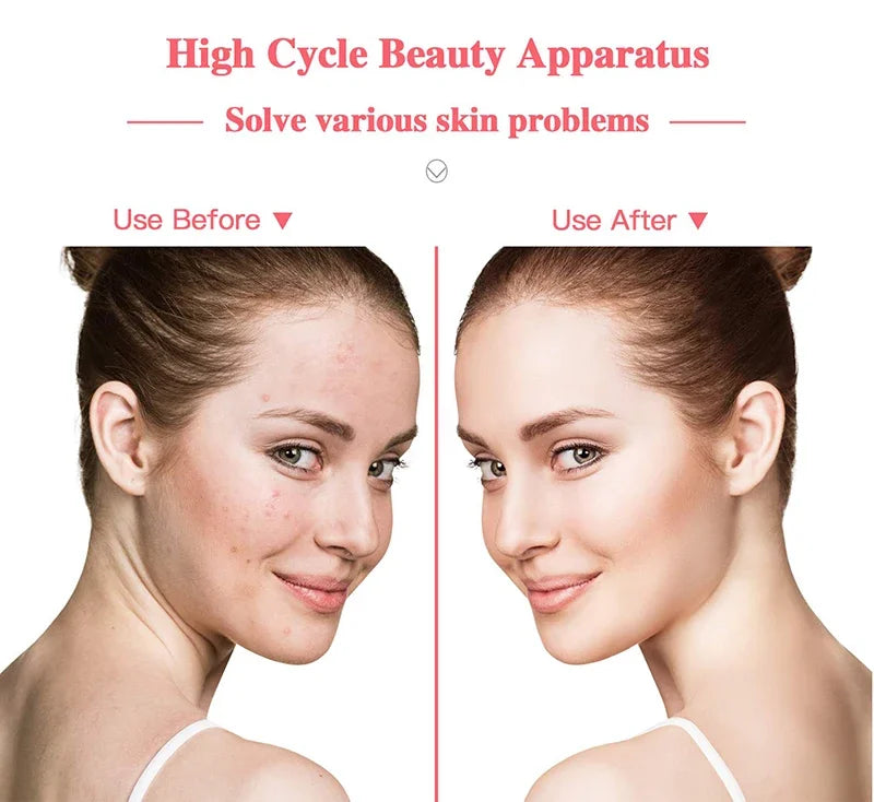 Appareil portable de traitement de l'acné pour le visage, appareil de beauté électrique à haute fréquence.